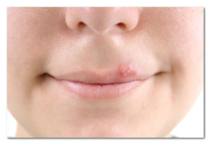  Brzo lečenje herpesa na usnama