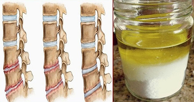 So i ulje: lekovita smesa protiv osteohondroza