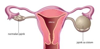 Kako izlečiti cistu na jajniku sa narodnim lekovima.