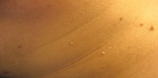 Narodni lekovi za lečenje papiloma (visećih bradavica)