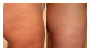 Efikasna prirodna metoda u borbi protiv strija. Krema protiv strija.