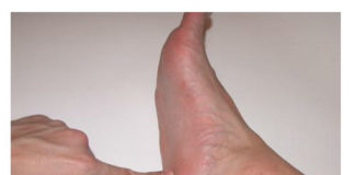 Petni trn ili petna bodlja. Kako se osloboditi bola u peti.