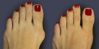 Kako se osloboditi čukljeva na nogama i rešiti se bolova u zglobovima