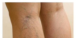 Proširene vene. Efikasno prirodno lečenje varikoznih vena.