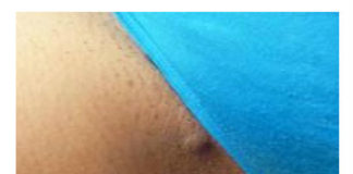 Urasle dlačice. Pravilna depilacija kože kod uraslih dlačica