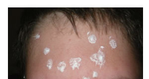 Pasta za zube kao radikalan način u borbi protiv bubuljica