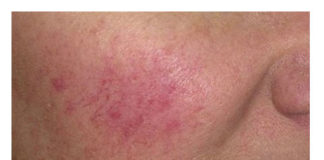 Kako izlečiti kuperozu – crvenilo i popucale kapilare na licu