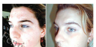 Čudesna maska za problematičnu kožu lica. Zaboravite na crvenilo, akne i mitisere.