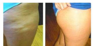 Domaća krema protiv celulita. Prvi rezultati već posle 7 dana!