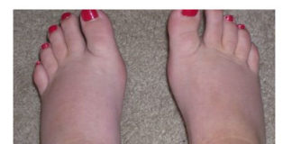 Imate otečene noge? Eliminišite otok na prirodni način.