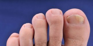 Gljivice na noktima. Kako izlečiti gljivičnu infekciju noktiju.