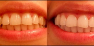 Za 5 minuta izbelite zube: Kako izbeliti zube aktivnim ugljem.