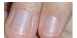 Kako se rešiti zanoktica