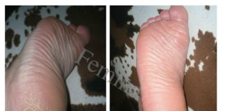 Recept protiv pukotina, žuljeva, grube kože na petama i tvrdih naslaga na stopalima