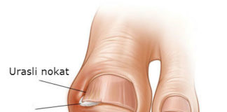 Kako lečiti urasli nokat na nozi u kućnim uslovima