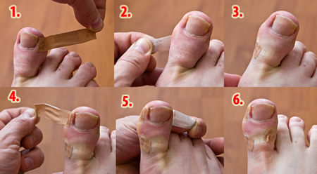 Kako lečiti urasli nokat na nozi u kućnim uslovima