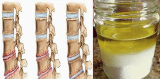 So i ulje: lekovita smesa protiv osteohondroza!