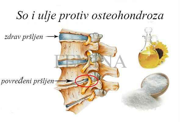 So i ulje: lekovita smesa protiv osteohondroza!