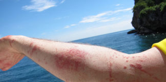Prva pomoć kod ujeda meduze. Korisno za one koji planiraju odmor na moru.