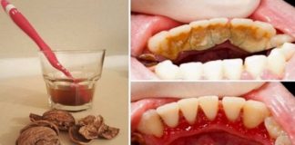 Kako ukloniti zubni kamenac pomoću jednog sastojka