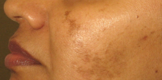 Kako se rešiti fleka na licu, pega i hiperpigmentacije