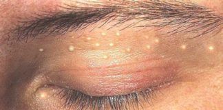 Kako ukloniti milie sa lica u kućnim uslovima