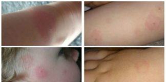 Sve o ujedima krpelja: Ovo je važno znati!