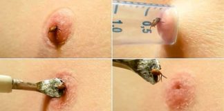 Kako ukloniti krpelja