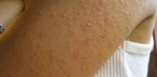 7 znakova netolerancije na gluten, koje mnogi ignorišu!