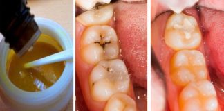 Kako preduprediti karijes