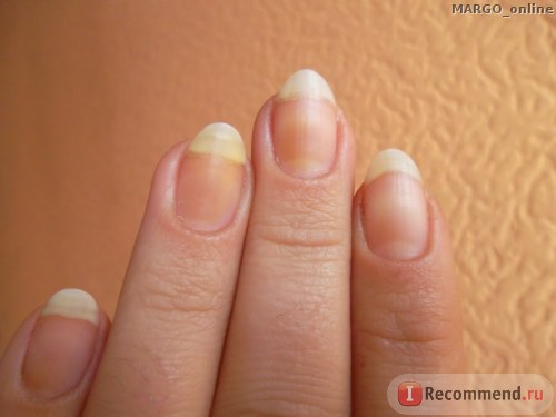 Kako koristiti povidon jod za nokte: