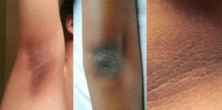 Oslobodite se tamnih fleka na vratu, ispod pazuha i unutrašnje strane butina