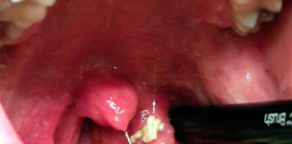 Evo, šta može biti uzrok neprijatnog zadaha iz usta: otkloni to, i rešićeš problem!