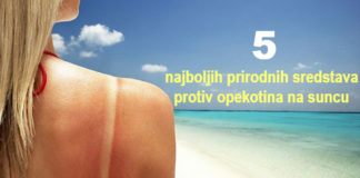 Šta raditi ako ste izgoreli na suncu