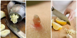 Sredstvo od belog luka i limuna protiv bradavica