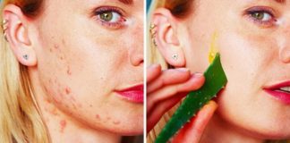 10 prirodnih preparata za tretiranje starih ožiljaka