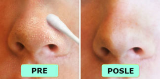 9 prirodnih sredstava koja će vaše lice spasti mitesera