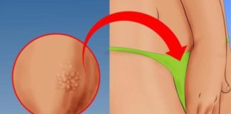 Kondilomi: Kako nastaju, simptomi i lečenje